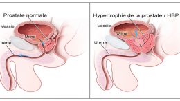 hypertrophie-benigne-de-la-prostate