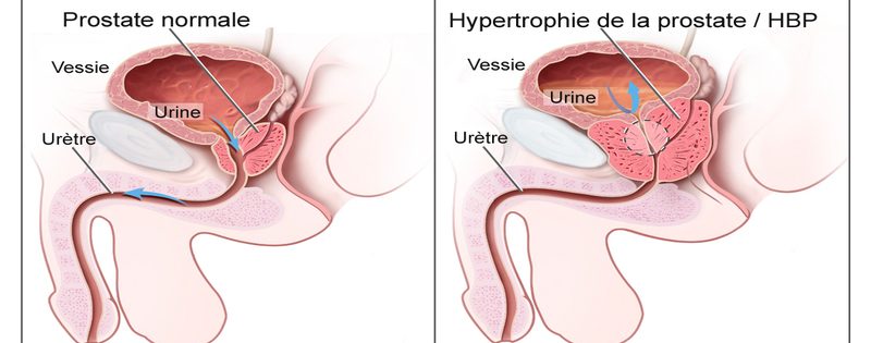 hypertrophie-benigne-de-la-prostate