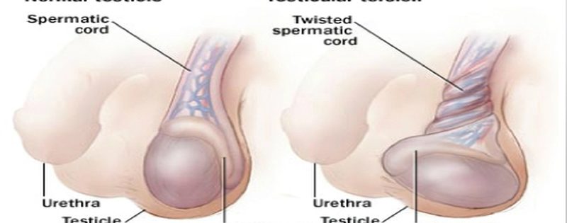 torsion-testiculaire