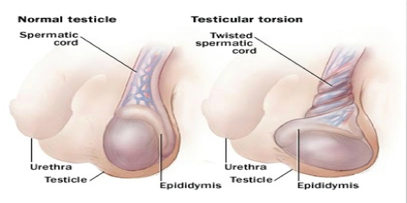 torsion-testiculaire